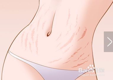 肚子上妊娠纹痒怎么办