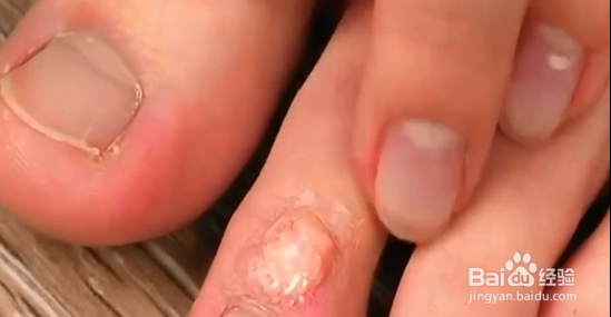 教你几个救护小技巧。