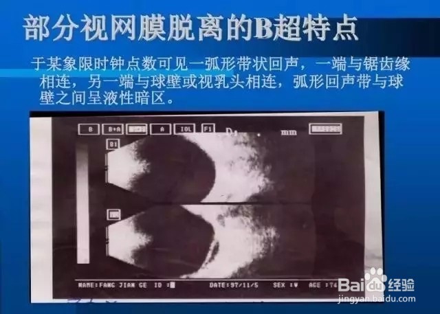 几种常见眼病B超图谱及诊断