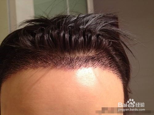 昆凌产后同样脱发，新妈妈发际线后移该咋办？