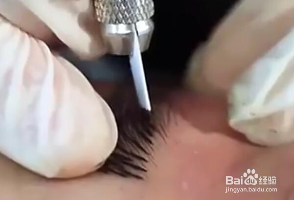 纹绣中途出血的预防及处理方法