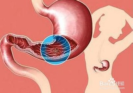 生活中能够诱发胃癌的因素有哪些？