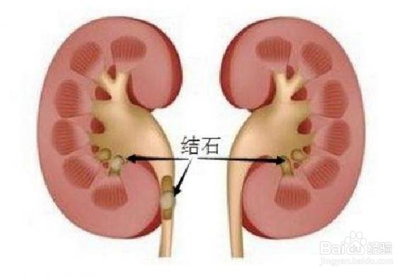 如何预防肾结石