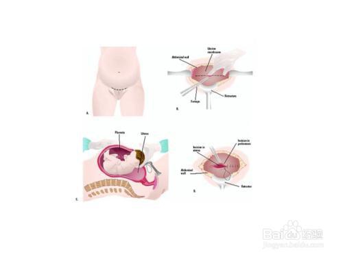 剖腹产后吃什么好妈妈们get到了没