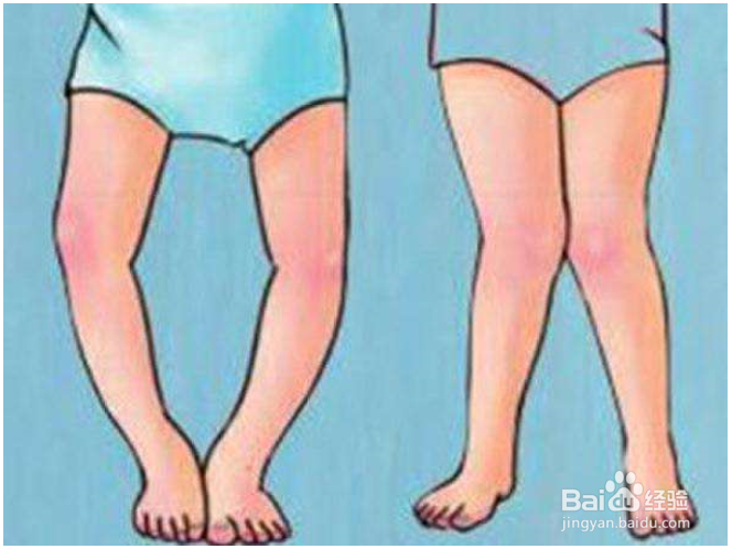 刚出生婴儿腿弯怎么办