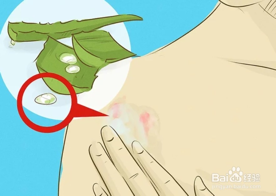 怎样用芦荟治疗灼伤？