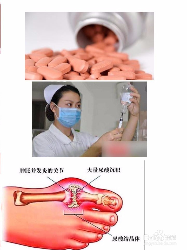如何缓解痛风患者疼痛及应注意的细节
