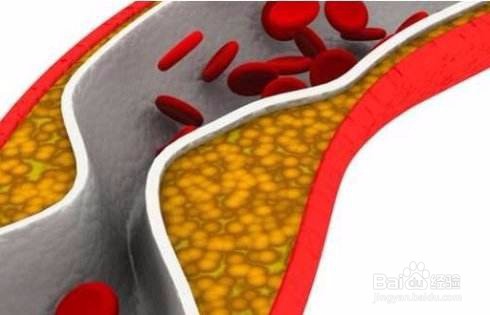 动脉硬化的原因及治疗方法