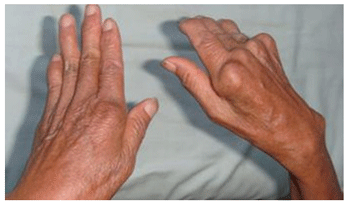 腰肌劳损怎么恢复?得了腰肌劳损怎么办?