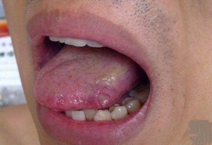 白塞氏病饮食注意事项