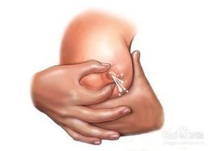 产后乳腺炎的预防与处理