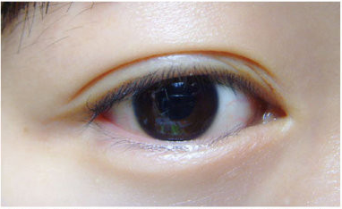 内双变成开眼角双眼皮的技巧