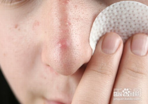 教你如何调理暗疮性皮肤