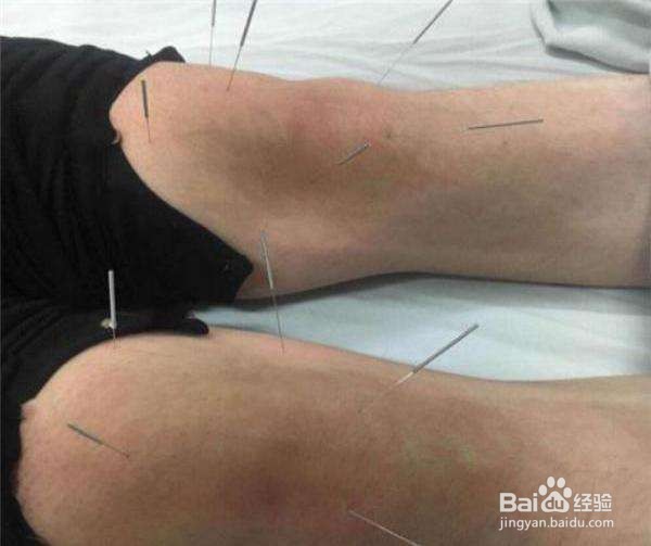 髌骨软化症可以跑步吗