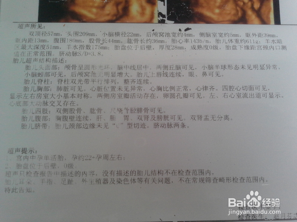 四维彩超到底查什么,有没有必要做?