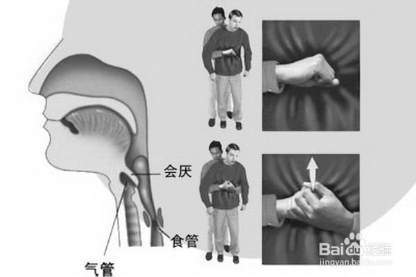 食物卡在喉咙了怎么办