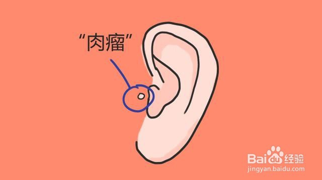 耳朵先天畸形的病因