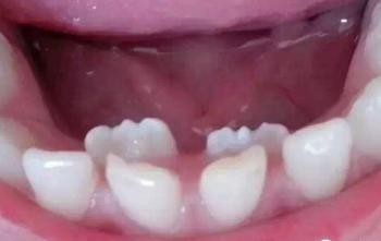 孩子换牙家长必须知道的事情