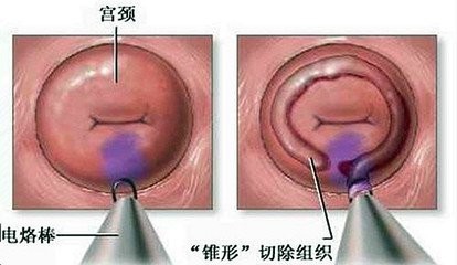 宫颈肥大是怎么回事