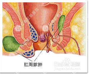 肛周脓肿术后注意事项