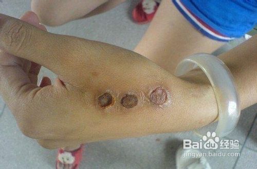 教你如何去除烟疤