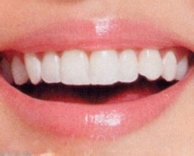 注意：九大坏习惯最伤害牙齿