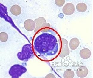 再生障碍性贫血的诱发原因