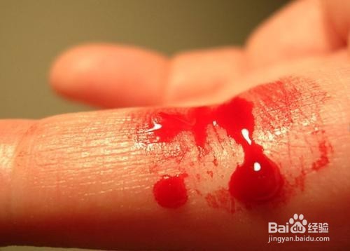 血友病有什么病症，会遗传吗？