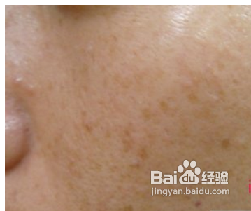 纯天然祛斑方法