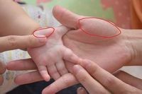 如何处理小孩肚子胀疼