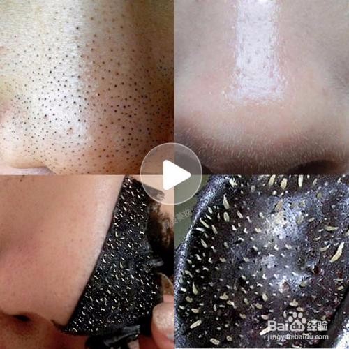 厦门祛黑头最有效的方法是什么？