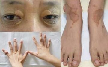 糖尿病足的早期症状 如何预防糖尿病足 百度经验