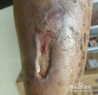 治疗老烂腿的方法