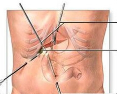 常见病辨别及处理：[1]胆石症