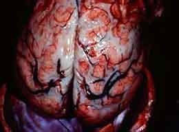 常见内科病之传染病治疗方法：[2]流行脑膜炎