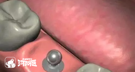 几张图让你看明白种植牙的过程！