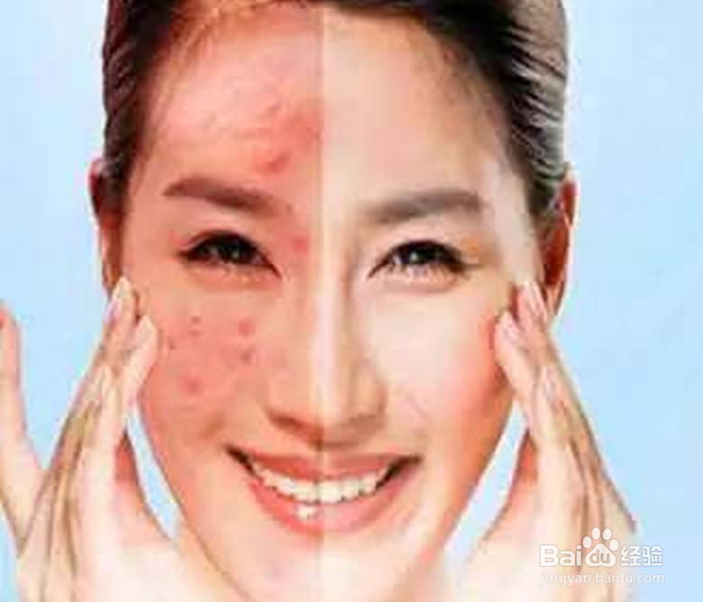 皮肤深层痘菌怎么清除