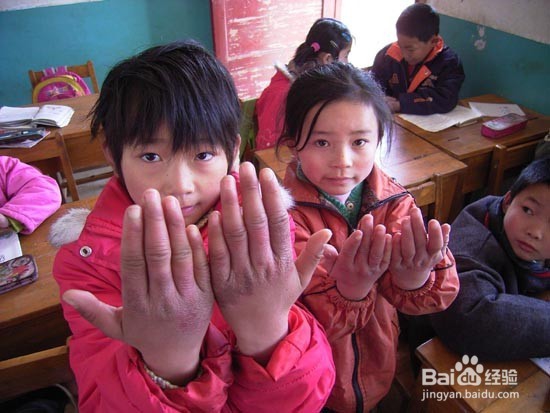 不用花钱处理冻伤的简易办法