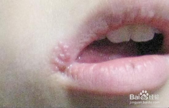 嘴角起泡怎么办?快速治疗版