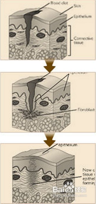 治疗开水烫伤疤痕的三步骤
