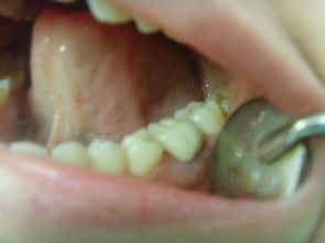 烤瓷牙为什么会出现黑线，出黑线怎么处理？