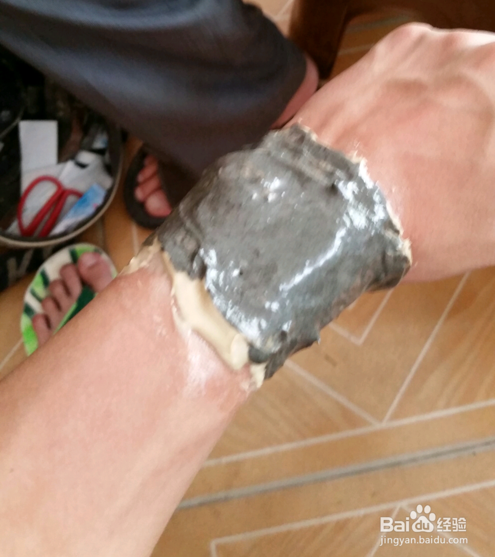 俯卧撑 倒立 臂力器锻炼中的手腕受伤怎么办
