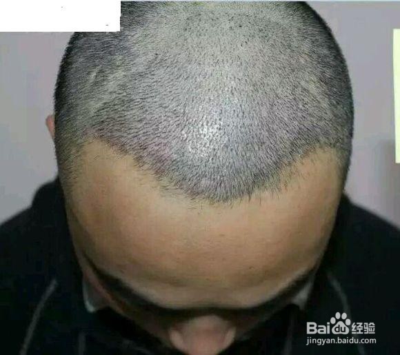 脑血管病的前兆