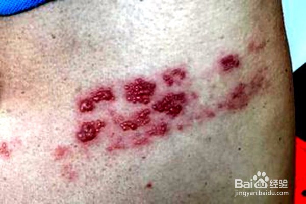 带状疱疹前期症状