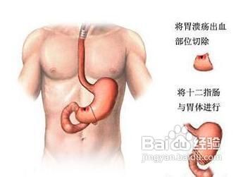 胃出血的危害有哪些