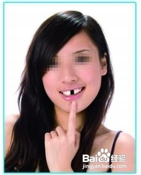 牙齿缺失了怎么办？