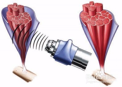 冲击波疼痛治疗仪的简介和使用方法