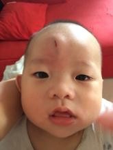 宝宝撞伤后必须立刻就医的情况