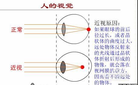 近视眼是如何造成