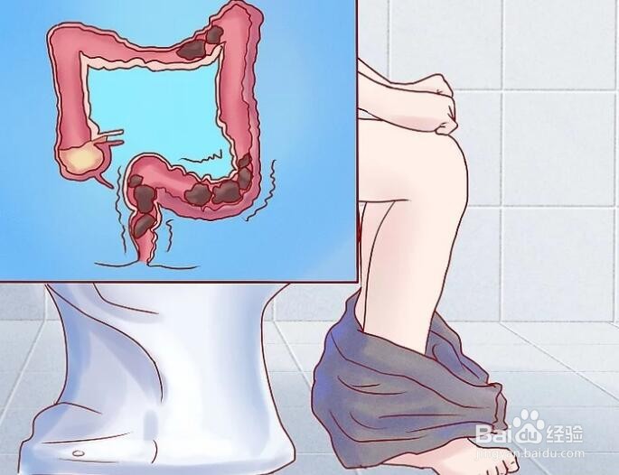 痔疮复发了怎么办